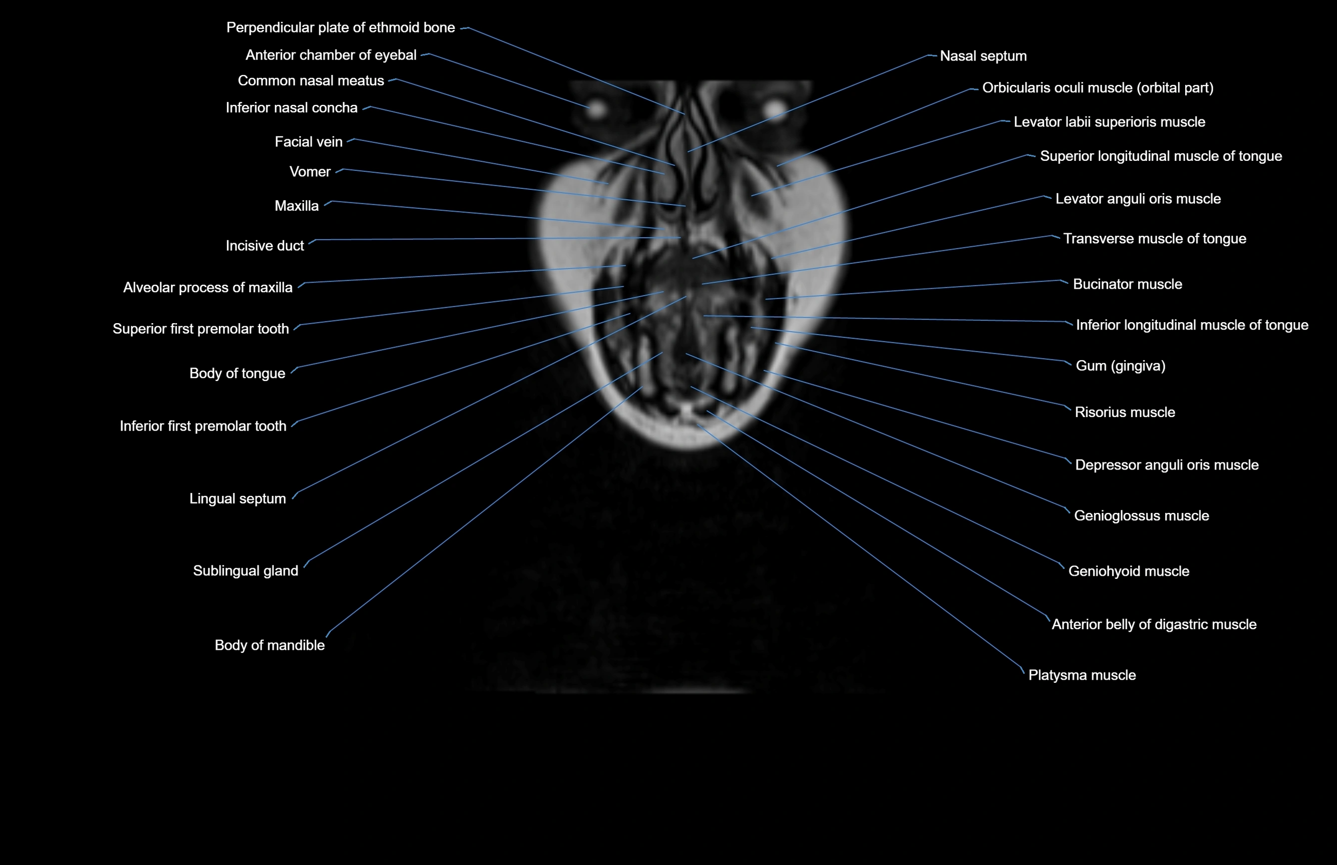 Neck coronal cross sectional MRI anatomy 3T MRI  image-img-00001-00071.webp